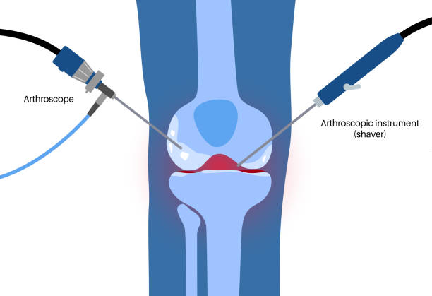 Best Arthroscopy ACL Reconstruction Surgeon in Borivali
