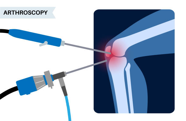 Best Arthroscopy ACL Reconstruction Surgeon in Chandavarkar Road,Borivali